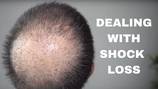 Shock Loss After a Hair Transplant and how to deal with it [upl. by Attenrad]