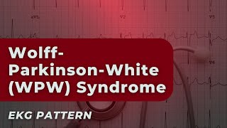 WolffParkinsonWhite WPW Syndrome Understanding Your EKG ECG [upl. by Ebanreb]