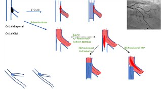 Ostial side branch stenting esp ostial diagonal algorithms and cases Elias Hanna [upl. by Dich]