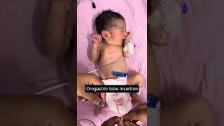 How to insert Orogastric feeding tube OG tube insertion Newborn baby 👶 [upl. by Aisenat]