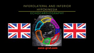 Echocardiography  Inferolateral And Inferior Hypokinesia [upl. by Aicil602]