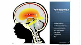 Hydrocephalus  Definition treatment and complications [upl. by Esorbma224]