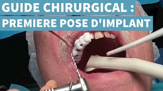 POSER SON 1ER IMPLANT EN CHIRURGIE GUIDÉE [upl. by Swithbert760]