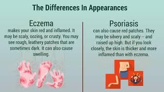 Psoriasis vs Eczema [upl. by Naerol]