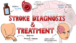 Stroke Diagnosis and Treatment  Acute and Long Term Treatment of Ischemic and Hemorrhagic Stroke [upl. by Gee]