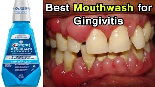 Top 3 Best Mouthwashes for Gingivitis Disease  Periodontal Disease [upl. by Eivets]