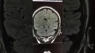 Mesial temporal sclerosis [upl. by Ekenna]