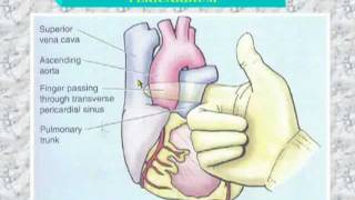 34 Transverse sinus of pericardium [upl. by Ashli266]