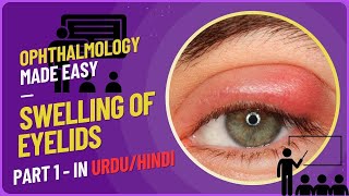 Understanding Eyelid Swellings A Comprehensive Guide to Hordeolum Chalazion Stye and Blepharitis [upl. by Hsakiv]