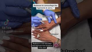 Radiesse Injections For The Hands [upl. by Ybreh]