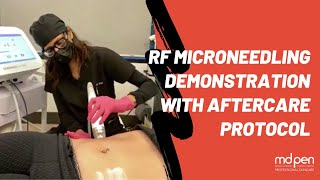 RF Microneedling Demonstration with AfterCare Protocol Rewatch [upl. by Oibesue]