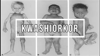 KWASHIORKOR [upl. by Bilski]