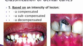 Classification of Cavities by Black Principles of Cavities Preparation Composite Materials [upl. by Cyrus67]