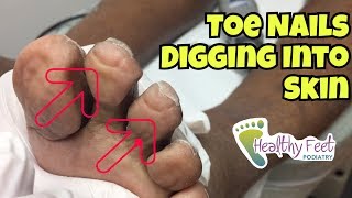 Nails Curling Into Toes  Nail Trimming for Diabetic Ingrown Nails at the Ends of the Toe [upl. by Hendrick]