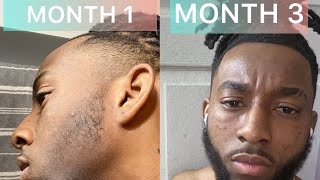 Minoxidil Beard Journey  4 Month Transformation  Before and After [upl. by Formenti]