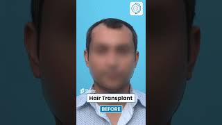 Hair Transplant by Derma Circles  Hair Transplant Results hairtransplant shortsfeed shorts [upl. by Htrahddis]