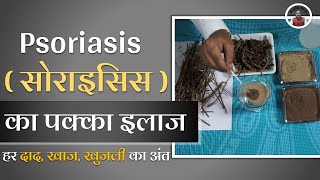 Best psoriasis treatment in Hindi  Ayurved shala [upl. by Omura]