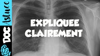 🔴 Dr Astuce  3 ANOMALIES RADIO THORAX EXPLIQUÉES CLAIREMENT  PARTIE 1 [upl. by Lentha]