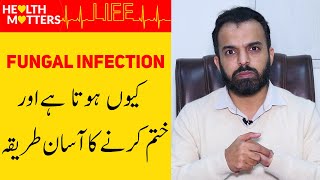 Fungal Infection Treatment  Fungal Infection of Skin In UrduHindi  Fungus Ka Ilaj [upl. by Lladnor]