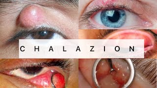 Chalazion  Ophthalmology  EASY MBBS [upl. by Seamus]