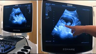 SURPRISE ULTRASOUND TWINS  Twins on Ultrasound Reaction [upl. by Cumine525]