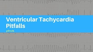 Ventricular Tachycardia Pitfalls [upl. by Antebi]