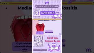 Median Rhomboid Glossitis  Oral Medicine  Medi Study Go [upl. by Itsa]