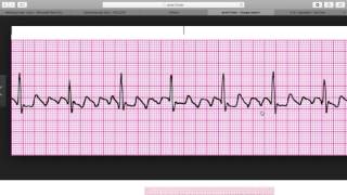 Atrial Flutter [upl. by Colton]