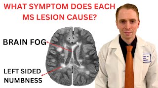 What Symptom Does Each Multiple Sclerosis MRI Lesion Cause Neurologist Explains [upl. by Eelibuj]