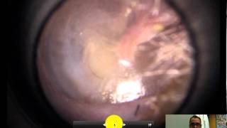 normal ear exam of the tympanic membrane [upl. by Asoj]