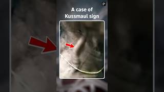 Case of Kussmauls sign [upl. by Wenona]