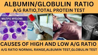 ALBUMIN TO GLOBULIN RATIOAG RATIO TESTHIGH AND LOW AG RATIOAG RATIO INLIVER AND KIDNEY PROBLEM [upl. by Wolfie]