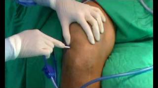 Septic arthritis of the knee arthroscopic debridement [upl. by Aciraj]