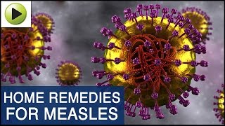 Skin Care  Measles  Natural Ayurvedic Home Remedies [upl. by Attolrahc]