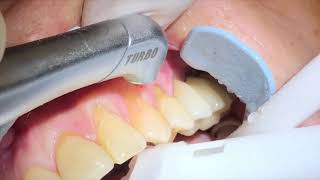 Laser tooth cavity prepared with Waterlase iplus [upl. by Htnnek]