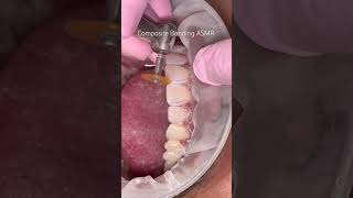 ASMR 🔊 Dr Kunal Desai at work veneers compositebonding dentist asmr asmrsounds [upl. by Aehsat]