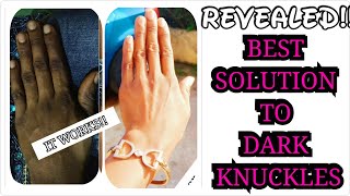 Just Two Ingredients to Clear Dark Knuckles Fastest Way To Get Rid of Dark knucklesToes [upl. by Belding]