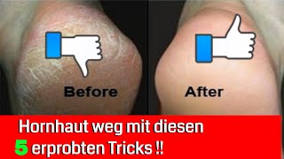 5 erprobte Tricks um extreme Hornhaut zu entfernen [upl. by Oruam]