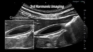 A demonstration of 3rd Harmonic Imaging [upl. by Crenshaw]