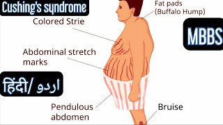 Cushing Syndrome in Hindi [upl. by Arahsal]