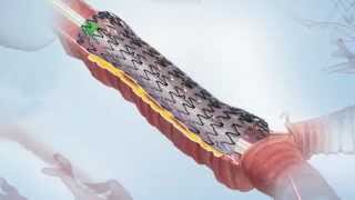 AERO® Fully Covered Tracheobronchial Stent Video [upl. by Ruhtracm]