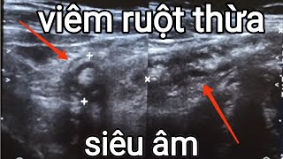 siêu âm viêm ruột thừa cấp  Ultrasound of acute appendicitis [upl. by Zhang]