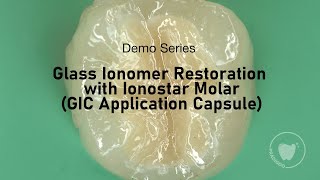 Glass Ionomer Restoration with Ionostar Molar GIC Application Capsule  VOCO GmbH [upl. by Llehsam]