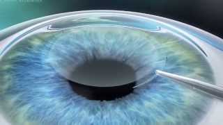 ZEISS Visumax femtosecond laser ReLEX SmiLE procedure [upl. by Vokay]