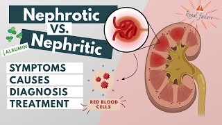 Nephrotic vs Nephritic syndrome  Symptoms diagnosis causes treatment  Visual explanation [upl. by Ytsihc321]