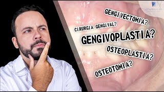 GENGIVOPLASTIA GENGIVECTOMIA CIRURGIA GENGIVAL SAIBA A DIFERENÇA drrowanvilar [upl. by Montagu]