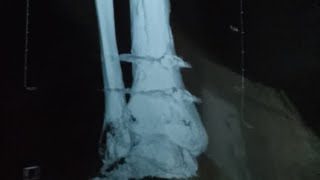 My Tibia Fracture recovery Experience Always with You Live streaming of OnlyOneEarth [upl. by Liakim]