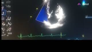 Global hypokinesia severe lv severe as mild mr [upl. by Melony]