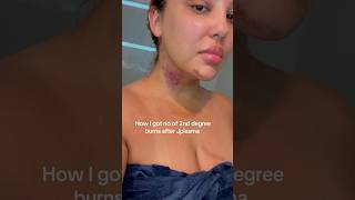 Getting rid of 2nd degree burns after chin lipo [upl. by Enelyt]