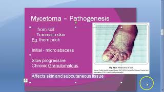 Microbiology 578 a Mycetoma foot Madurella mycetomatis Maduramycosis mycosis Eumycetoma Welsh regime [upl. by Anniala558]